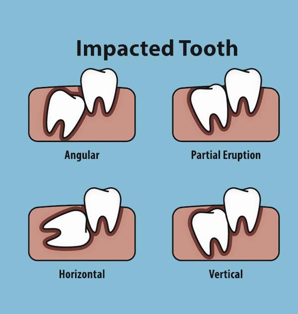 Is Wisdom Teeth Surgery Considered a Major Procedure? - Dr Implant Dentist